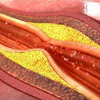 Koroner arter hastalığına yol açan 11 risk faktörüne dikkat
